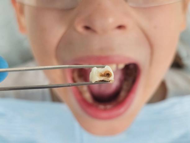 Best Emergency Tooth Extraction in South Whitley, IN