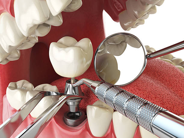 Best Emergency Denture Repair in South Whitley, IN